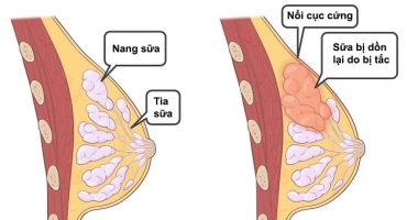 Sốt Do Tắc Tia Sữa: Nguyên Nhân, Cách Xử Lý Và Phòng Ngừa Hiệu Quả
