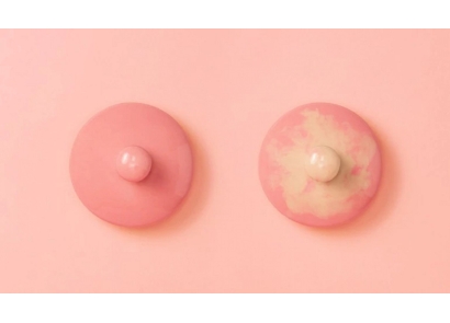 Tắc Tia Sữa Có Mủ: Nguyên Nhân, Cách Xử Lý Và Phòng Ngừa Hiệu Quả