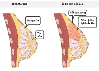 Sốt Do Tắc Tia Sữa: Nguyên Nhân, Cách Xử Lý Và Phòng Ngừa Hiệu Quả